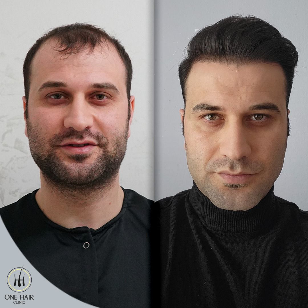Safir FUE - 12 Ay Sonrası