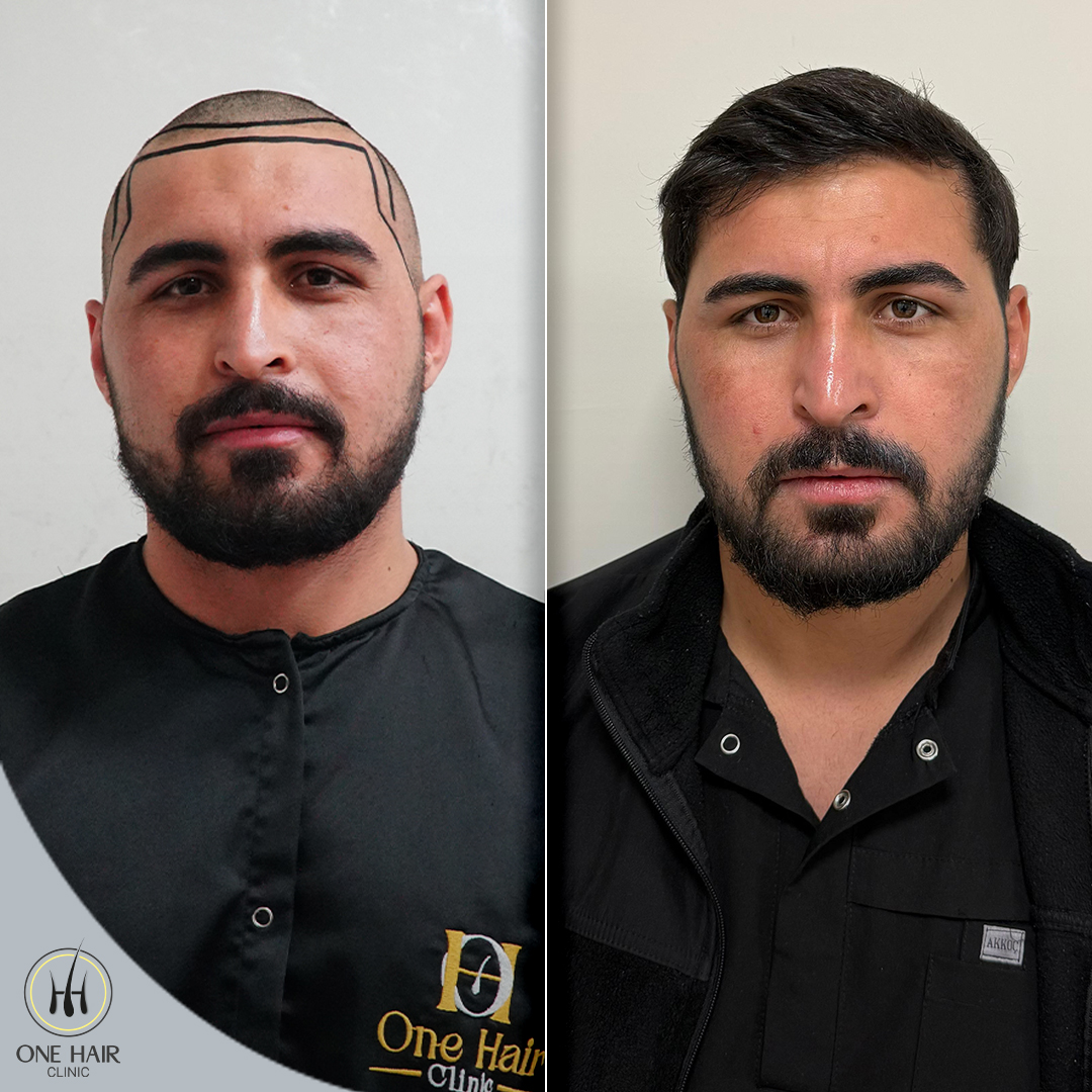 DHI Teknik - 10 Ay Sonrası