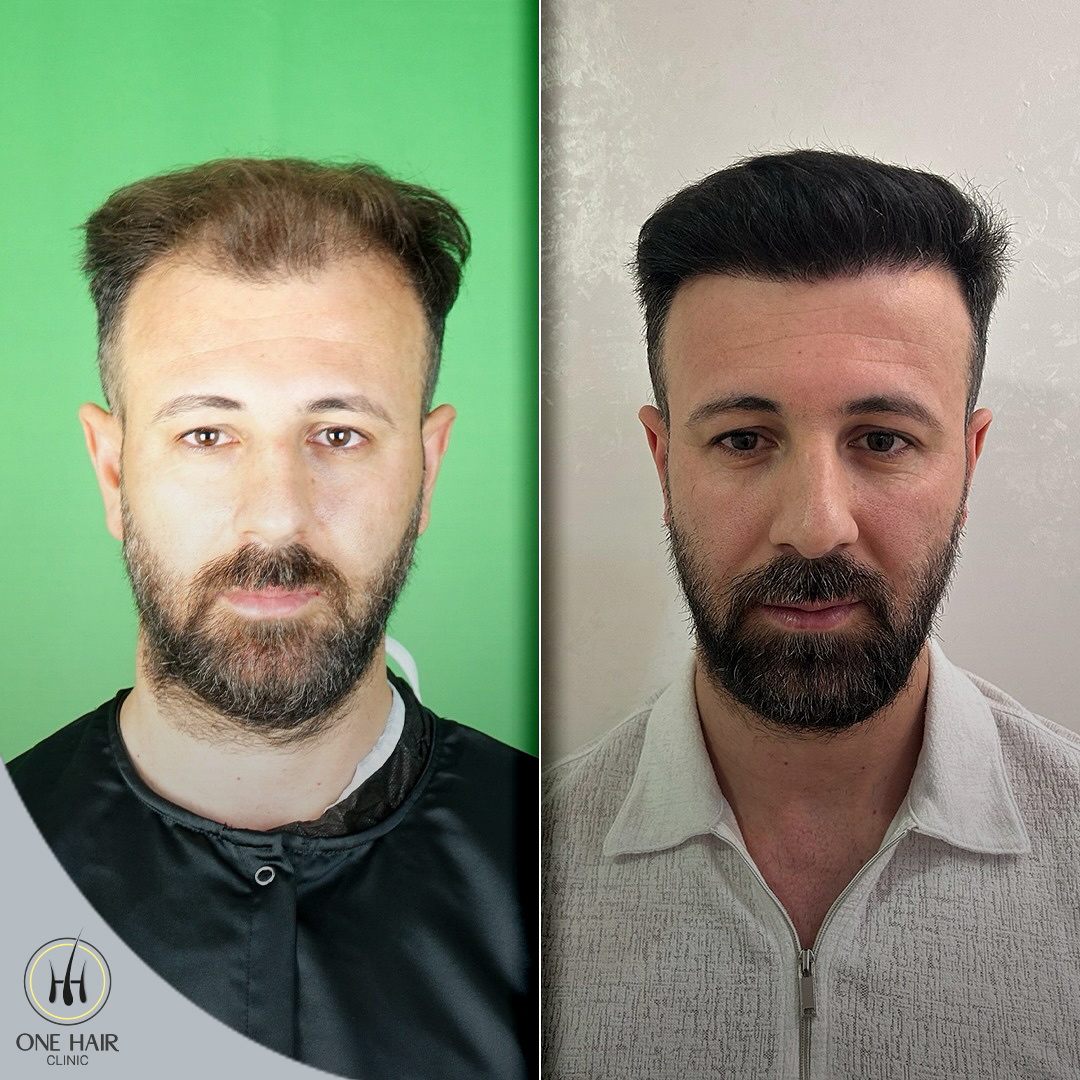 Hibrit Teknik - 14 Ay Sonrası