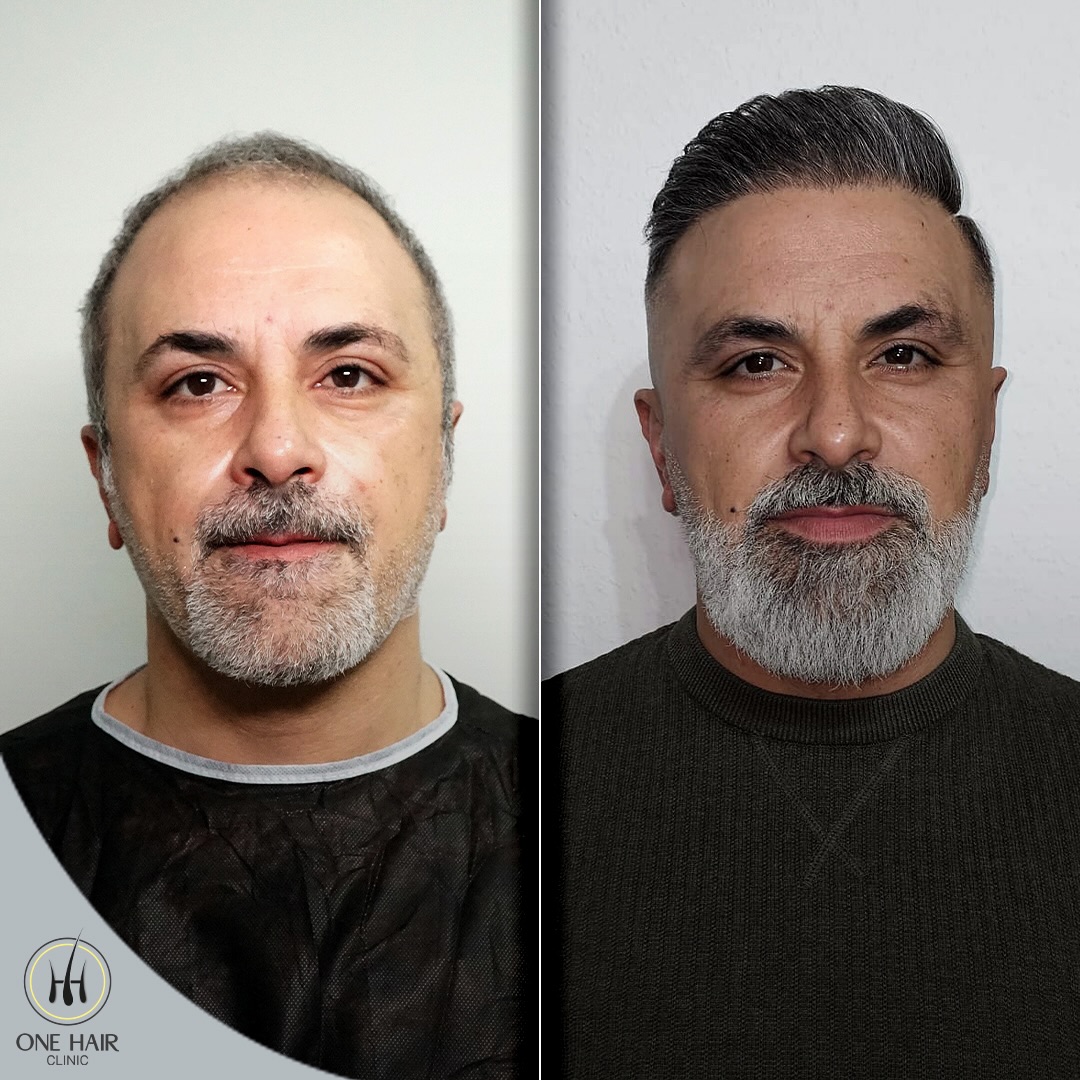 Safir FUE - 11 Ay Sonrası
