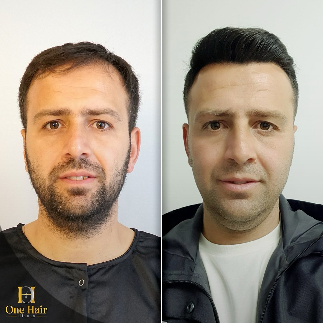 DHI Teknik - 13 Ay Sonrası