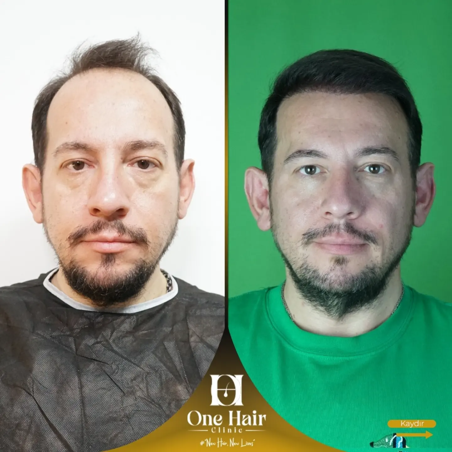 Safir FUE - 9 Ay Sonrası