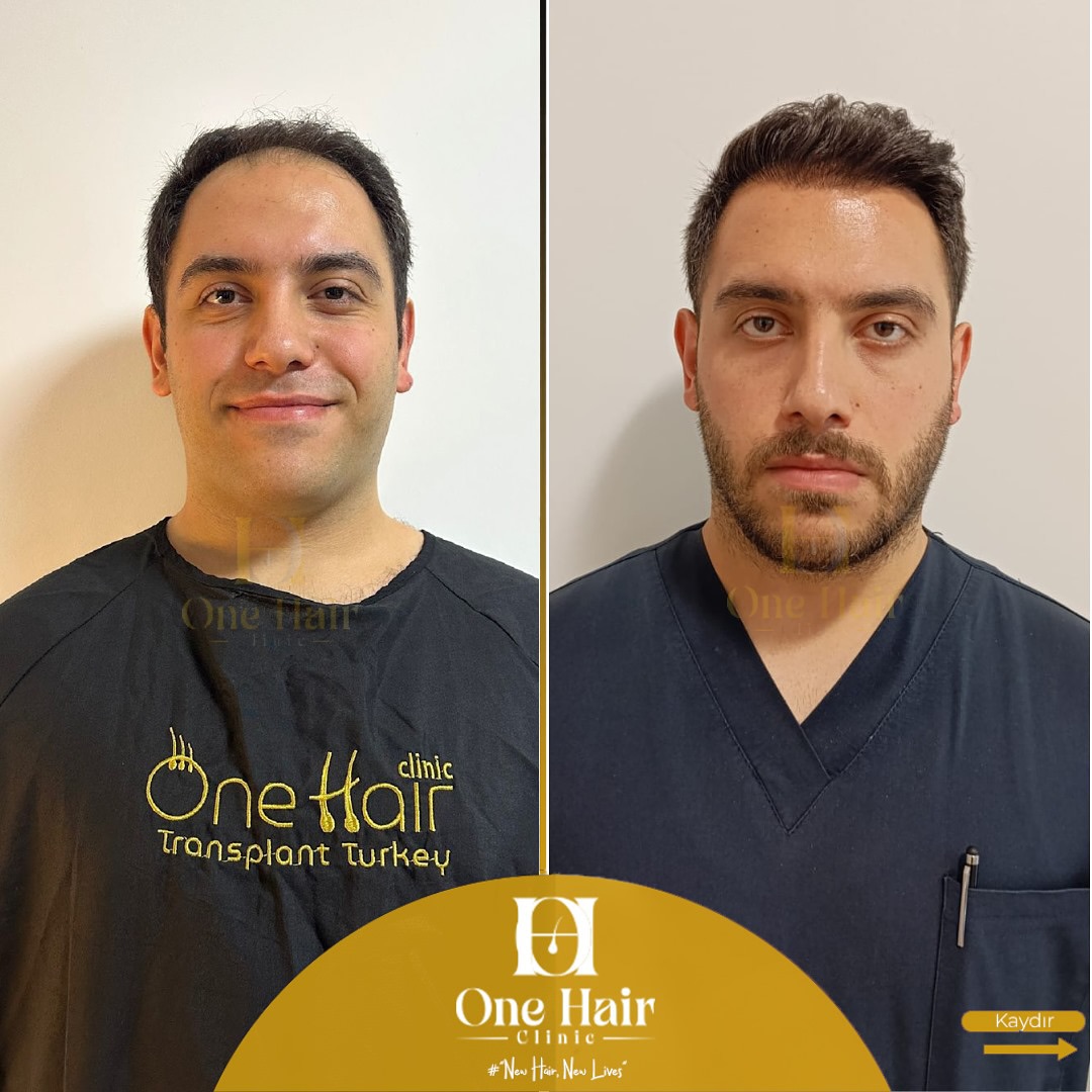 Hibrit Teknik - 16 Ay Sonrası