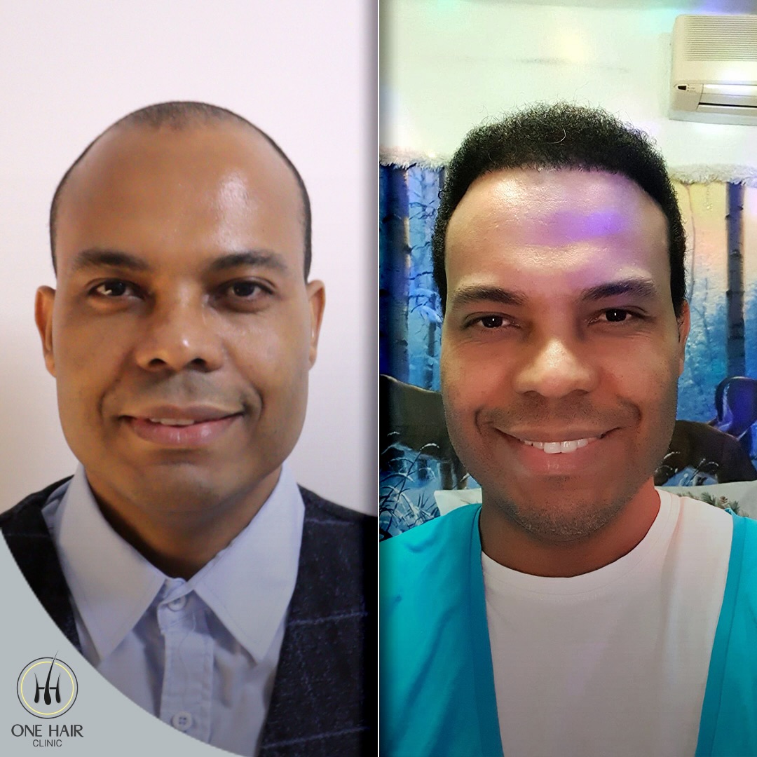 Safir FUE - 15 Ay Sonrası